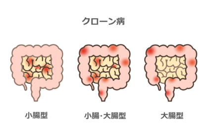 クローン病