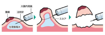 内視鏡的粘膜切除術（EMR）