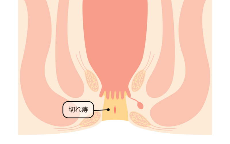 切れ痔　裂肛