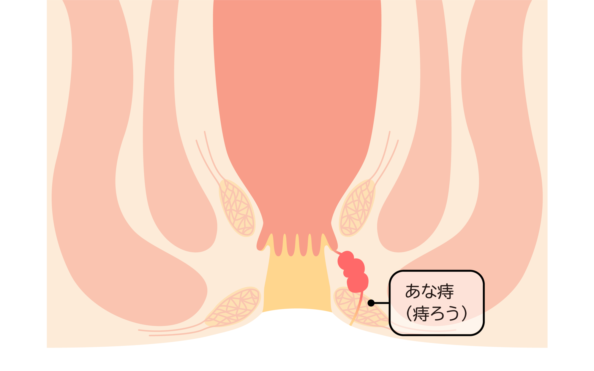 痔ろう　痔瘻　（あな痔）