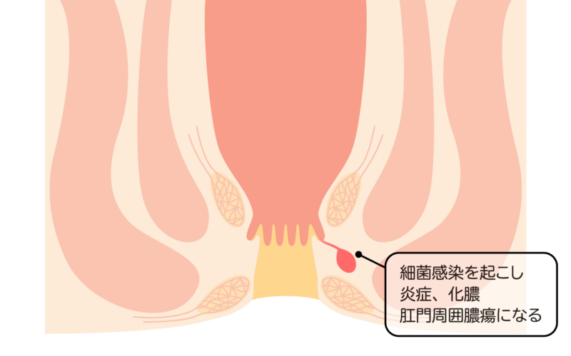 肛門周囲膿瘍